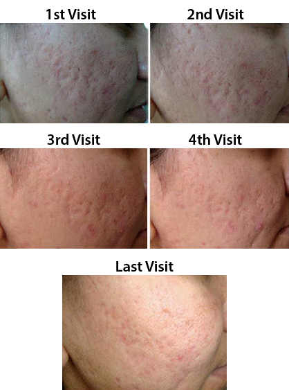results using microneedling for acne